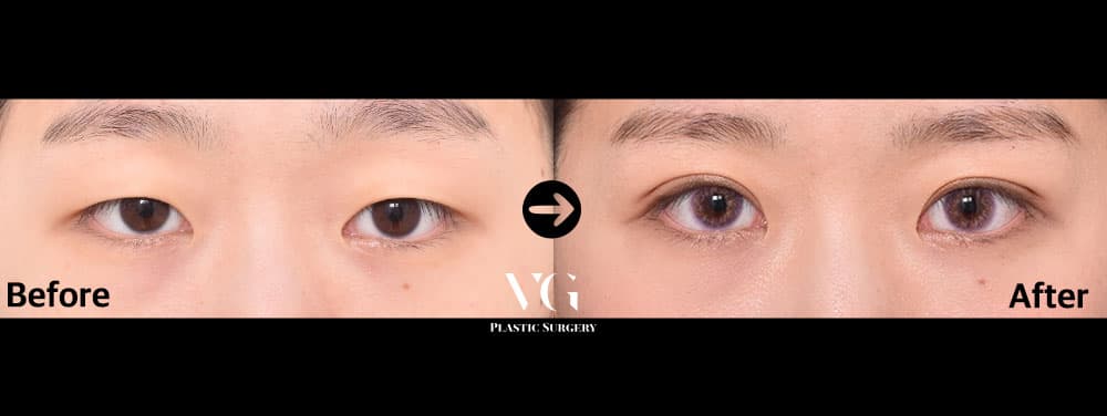 自然癒着二重 — アングル1