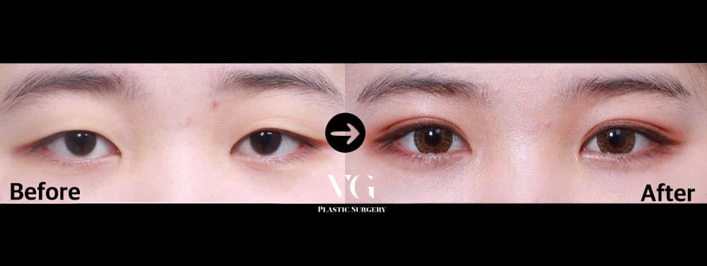 자연유착 쌍꺼풀 — 각도 1