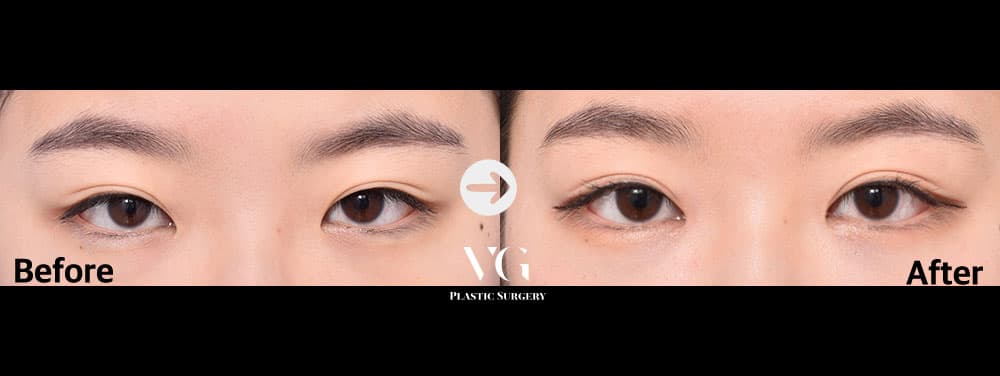 埋没二重 + 目頭切開 + 非切開眼瞼下垂矯正 — アングル1