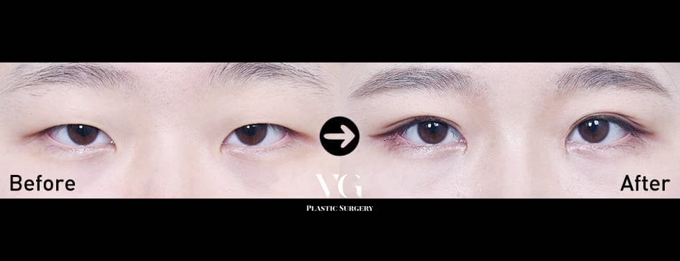 非切開眼瞼下垂矯正 + 目頭切開