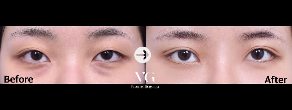 ตาสองชั้นแบบธรรมชาติ — มุมที่ 1