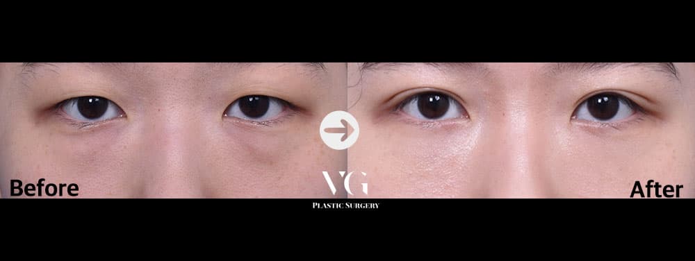 จัดเรียงไขมันใต้ตา — มุมที่ 1
