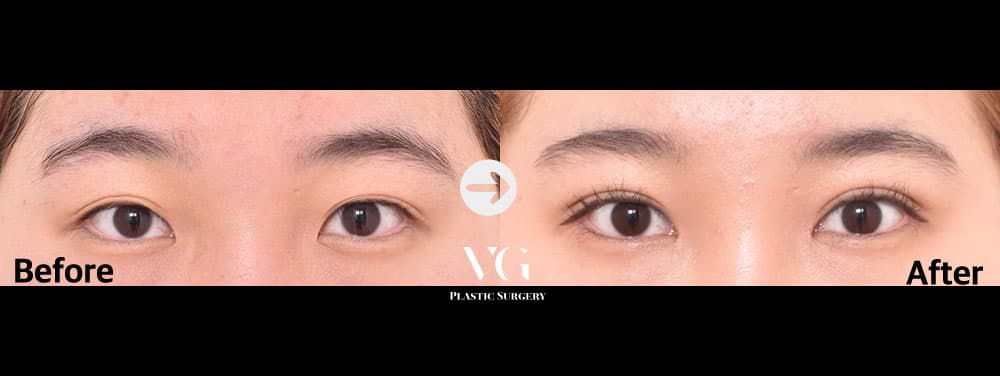 자연유착 쌍꺼풀 + 앞트임 — 각도 1