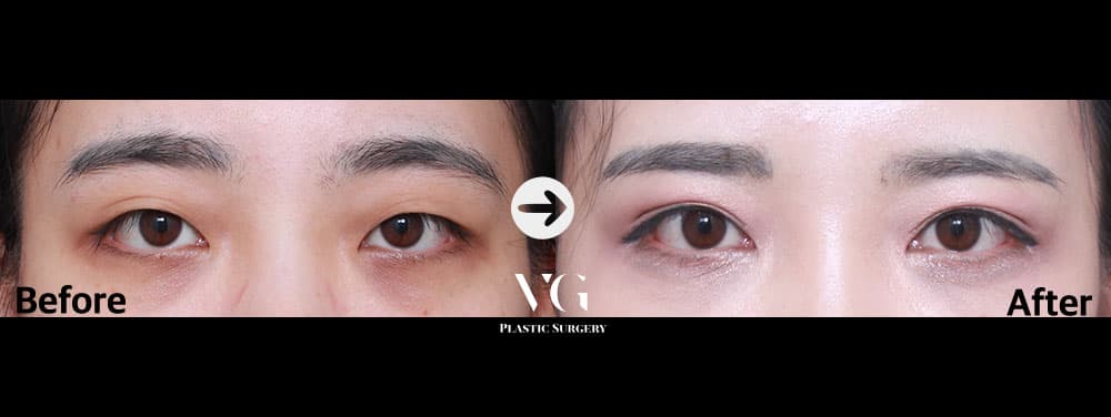 自然癒着二重 + 目頭切開 — アングル1