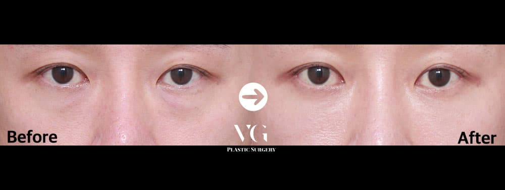 จัดเรียงไขมันใต้ตา — มุมที่ 1