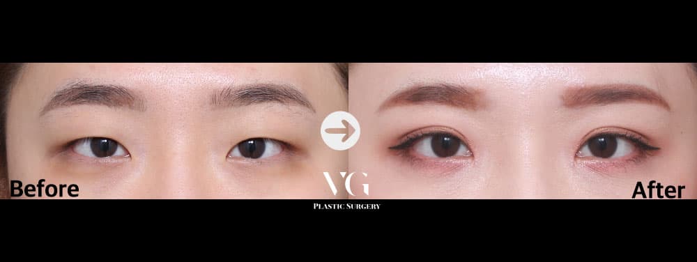 ตาสองชั้นแบบธรรมชาติ + เปิดหัวตา — มุมที่ 1