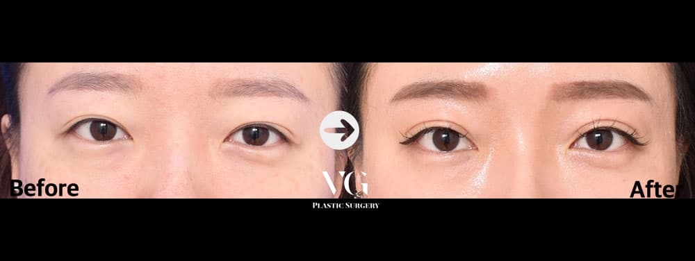 눈 재수술 + 자연유착 쌍꺼풀