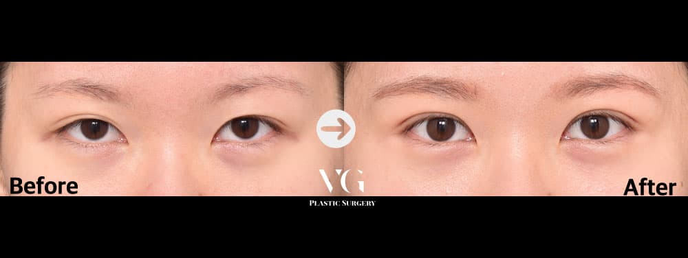 눈 재수술 + 자연유착 쌍꺼풀