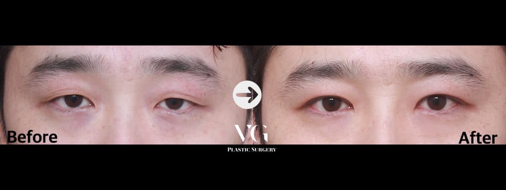 절개 쌍꺼풀 + 절개 눈매교정 — 각도 1