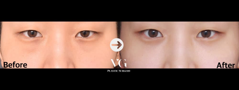 จัดเรียงไขมันใต้ตา — มุมที่ 1
