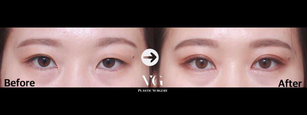 ตาสองชั้นแบบธรรมชาติ + แก้ไขกล้ามเนื้อตาแบบไม่กรีด + เปิดหัวตา