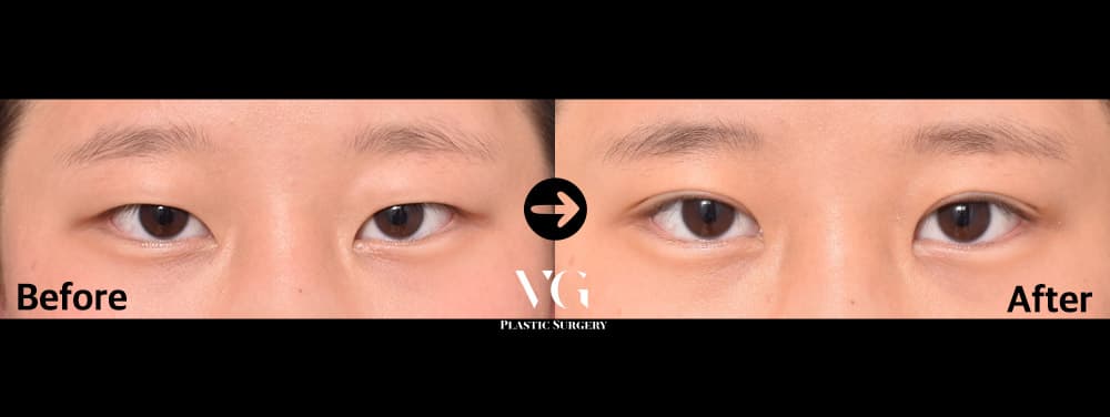 자연유착 쌍꺼풀 + 비절개 눈매교정 — 각도 1
