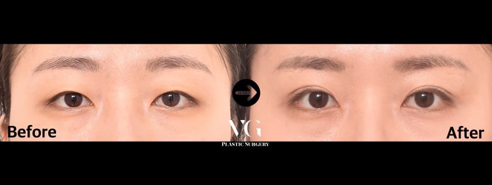자연유착 쌍꺼풀 — 각도 1