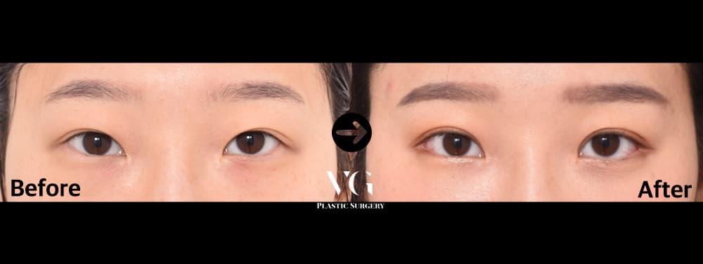 눈 재수술 + 자연유착 쌍꺼풀 — 각도 1