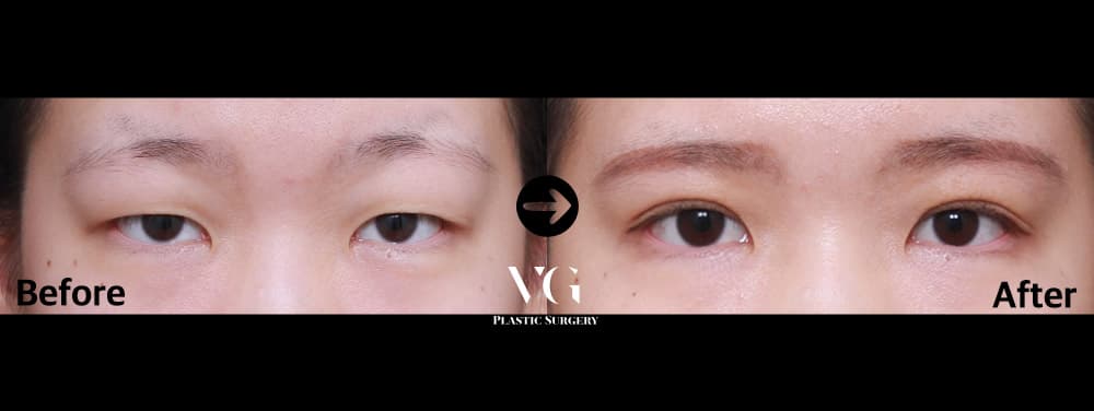 자연유착 쌍꺼풀 — 각도 1