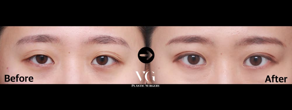 ตาสองชั้นแบบธรรมชาติ + แก้ไขกล้ามเนื้อตาแบบไม่กรีด — มุมที่ 1