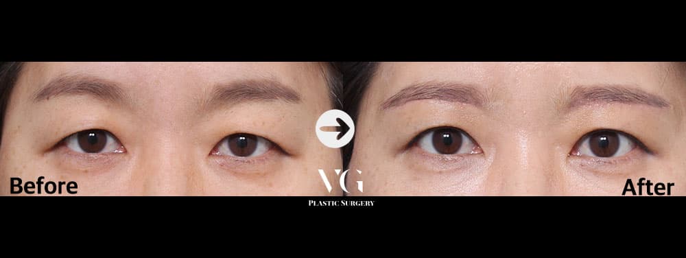 眉毛挙上 — アングル1