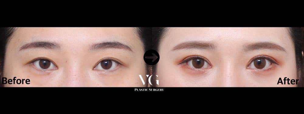 눈 재수술 + 절개 쌍꺼풀 + 절개 눈매교정 +2