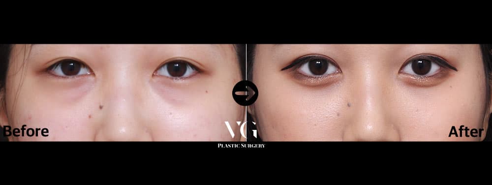 จัดเรียงไขมันใต้ตา — มุมที่ 1