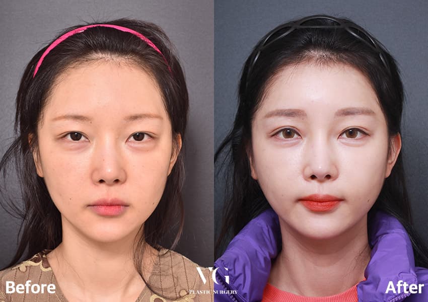 눈 재수술 + 절개 쌍꺼풀 + 절개 눈매교정