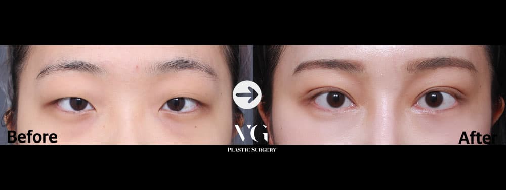 ตาสองชั้นแบบธรรมชาติ + แก้ไขกล้ามเนื้อตาแบบไม่กรีด + เปิดหัวตา +2