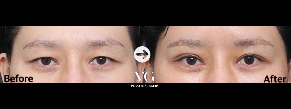 Eye Revision Surgery + Upper Blepharoplasty