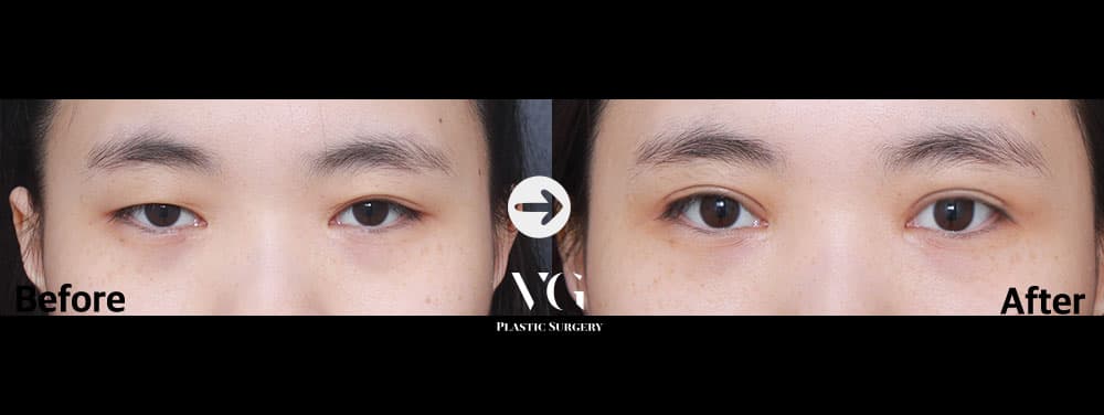 눈 재수술 + 절개 쌍꺼풀 — 각도 1