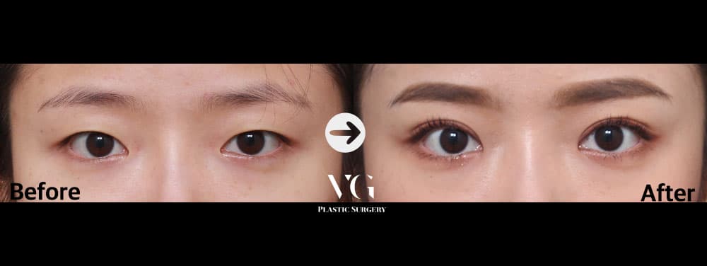 自然癒着二重 + 非切開眼瞼下垂矯正 — アングル1
