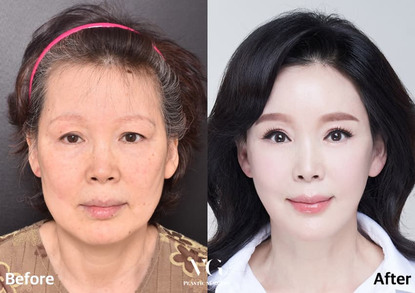 目の整形の術前術後 · 症例737