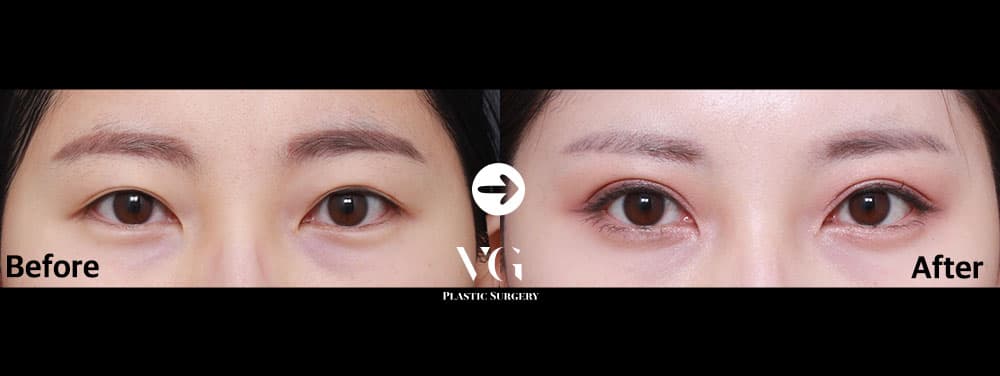 눈 재수술 + 절개 쌍꺼풀 — 각도 1