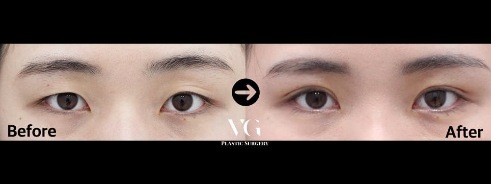 Natural-Adhesion Double Eyelid + Non-Incisional Ptosis Correction — View 1