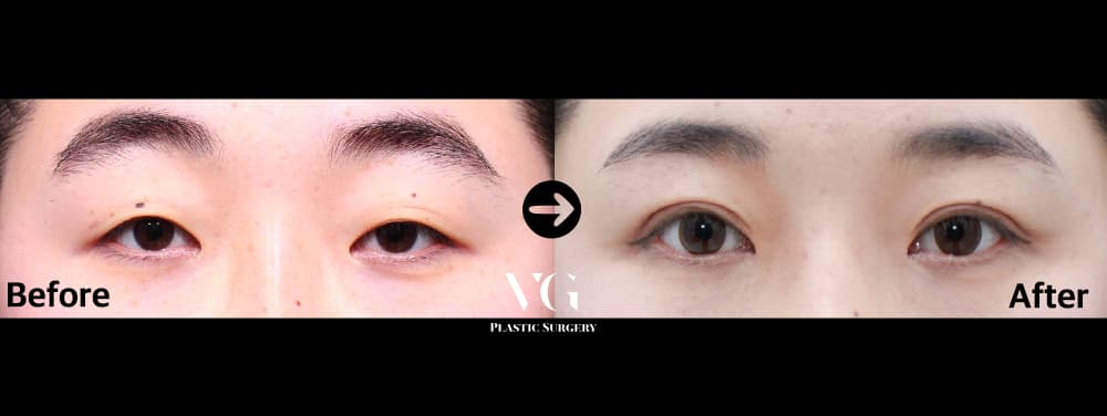 Eyes before and after — drag to compare
