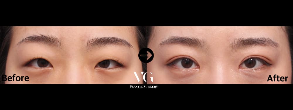 Natural-Adhesion Double Eyelid — before and after, VG Plastic Surgery