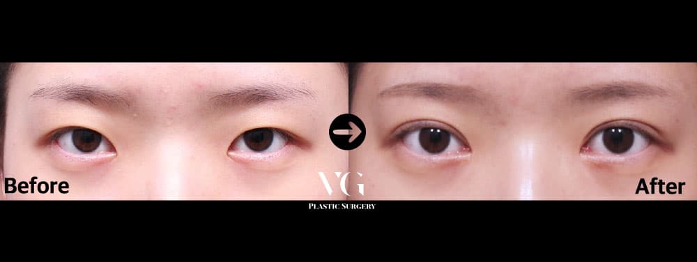Front view before and after eyelid surgery: heavy lids with no crease, then a low, natural double eyelid line and more open eyes