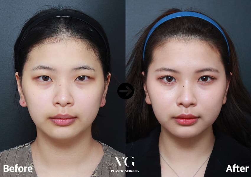 ตาสองชั้นแบบธรรมชาติ + แก้ไขกล้ามเนื้อตาแบบไม่กรีด + เปิดหัวตา