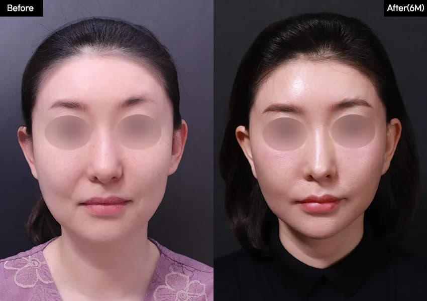 Before and after: Facelift