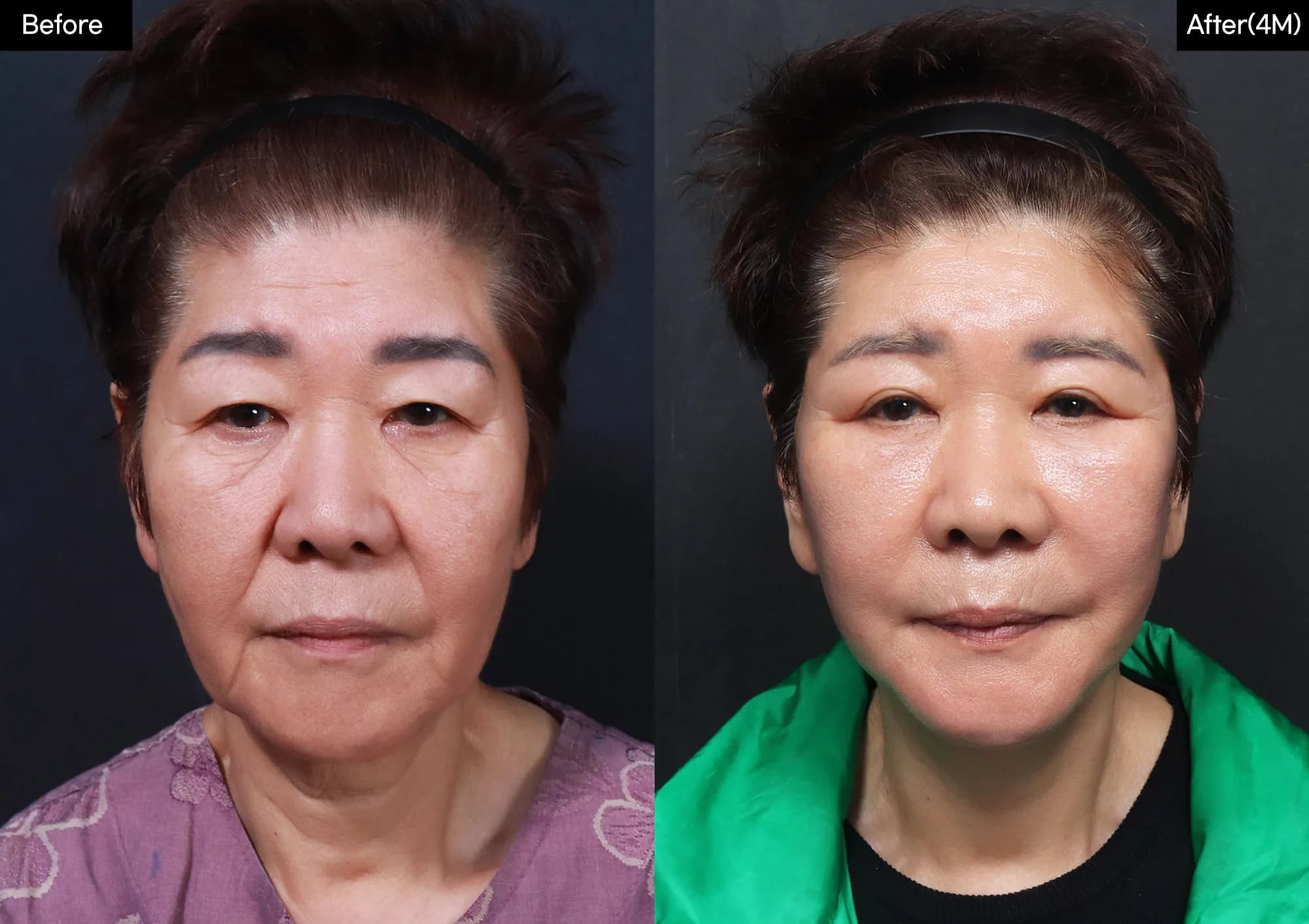 Before and after: Facelift