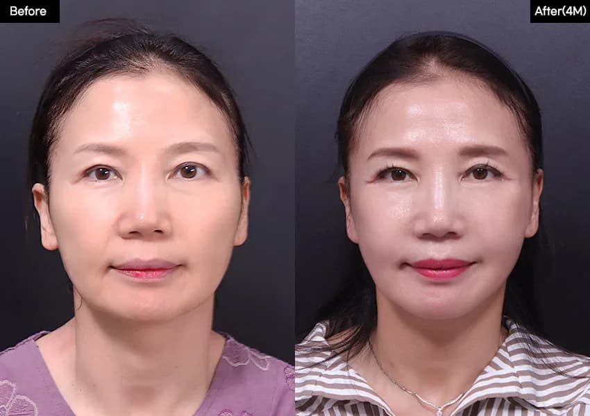 Before and after: Facelift