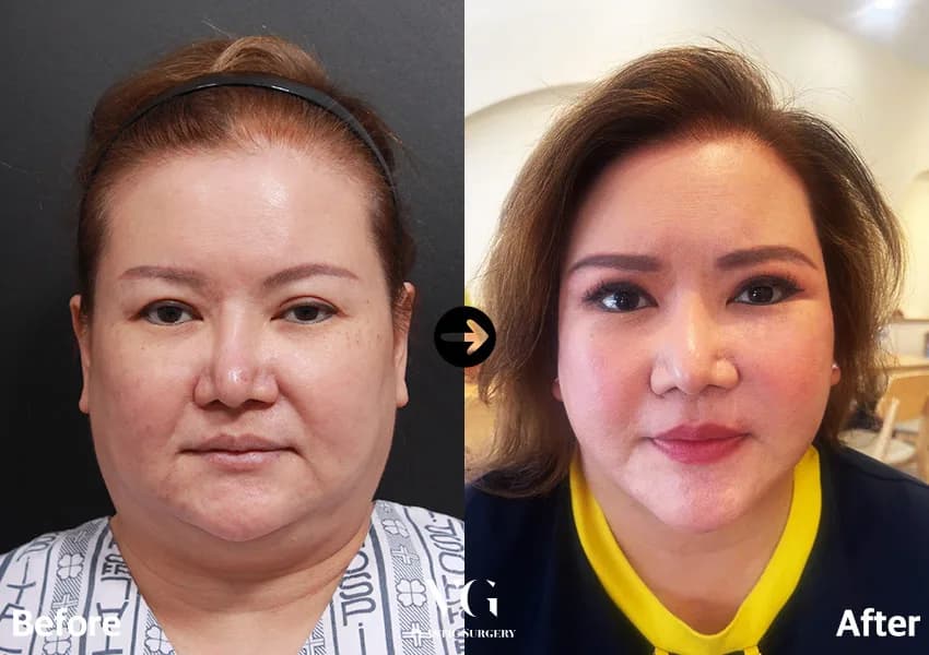 Before and after: Facelift