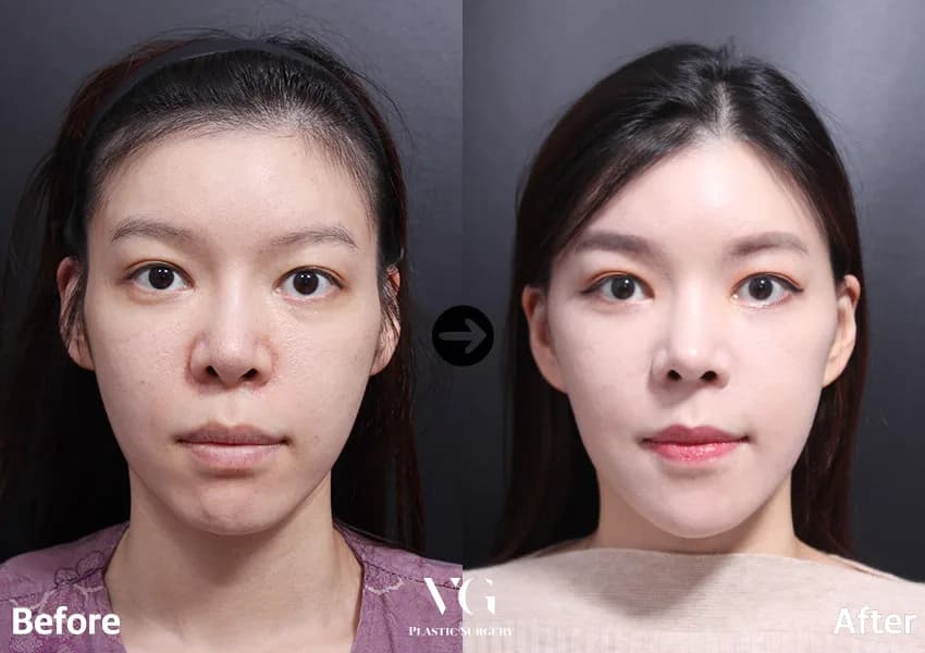 Before and after: Facelift