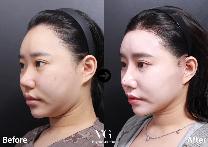 Before and after: Facelift