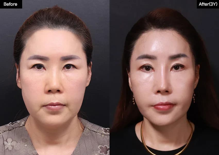 Before and after: Facelift