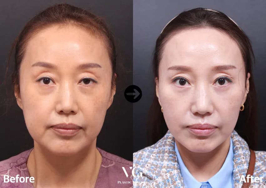 Before and after: Facelift