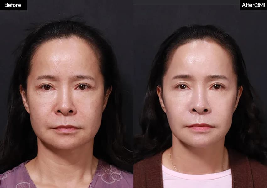 Before and after: Facelift