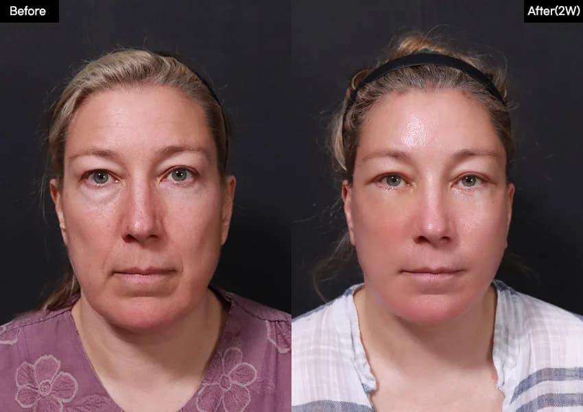 Before and after: Facelift