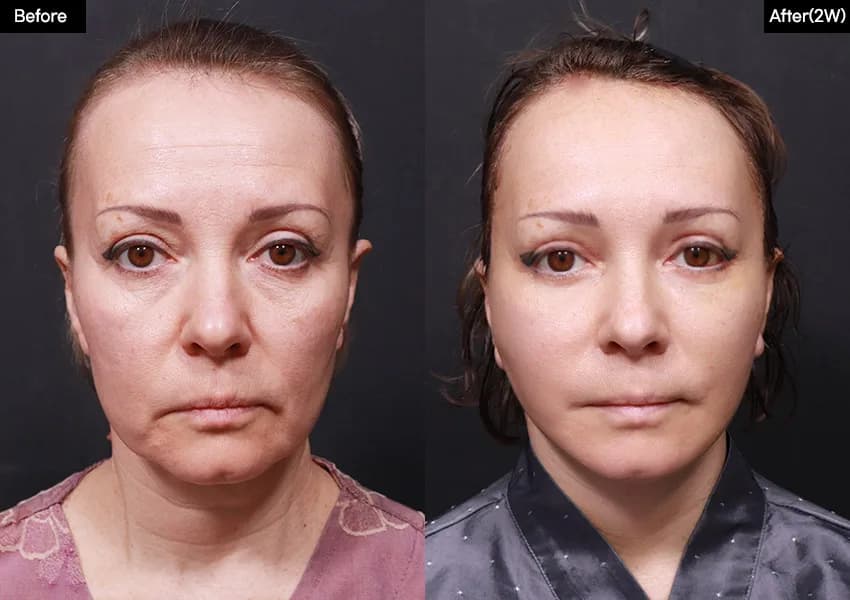 Before and after: Facelift