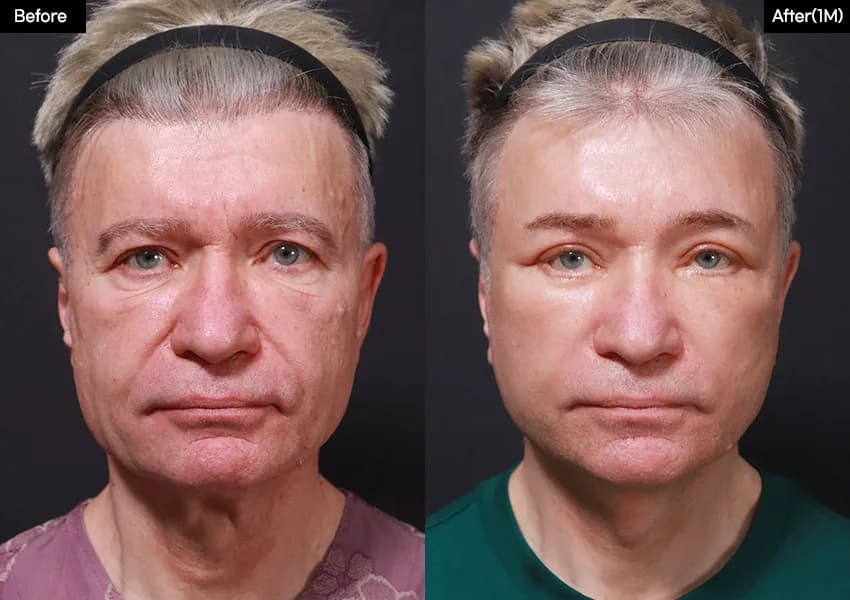 Before and after: Facelift