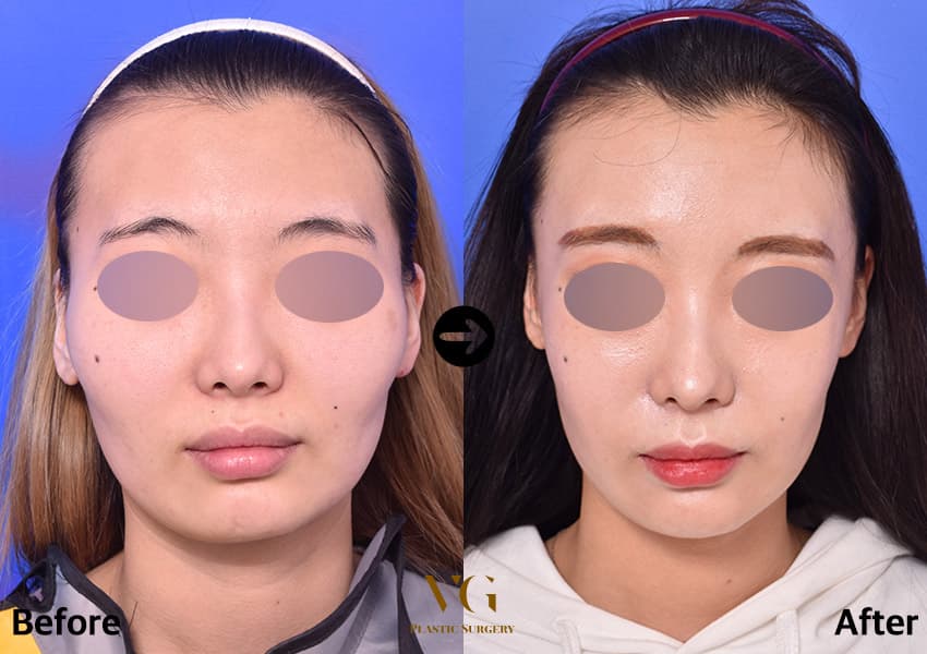 Before and after: Cheekbone (Zygoma) Reduction
