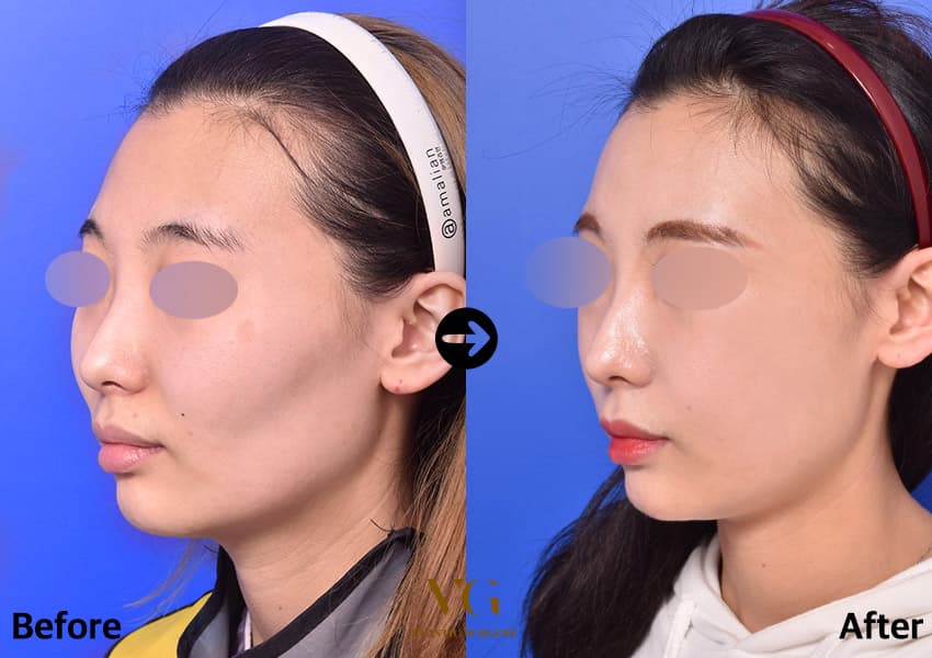 女性の斜めからの術前術後比較。術前は目の下から耳の前にかけて頬骨が外へ張り出し、術後は頬の上の段差がなだらかになっている