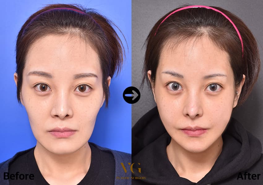 Facial contouring before and after — case 482